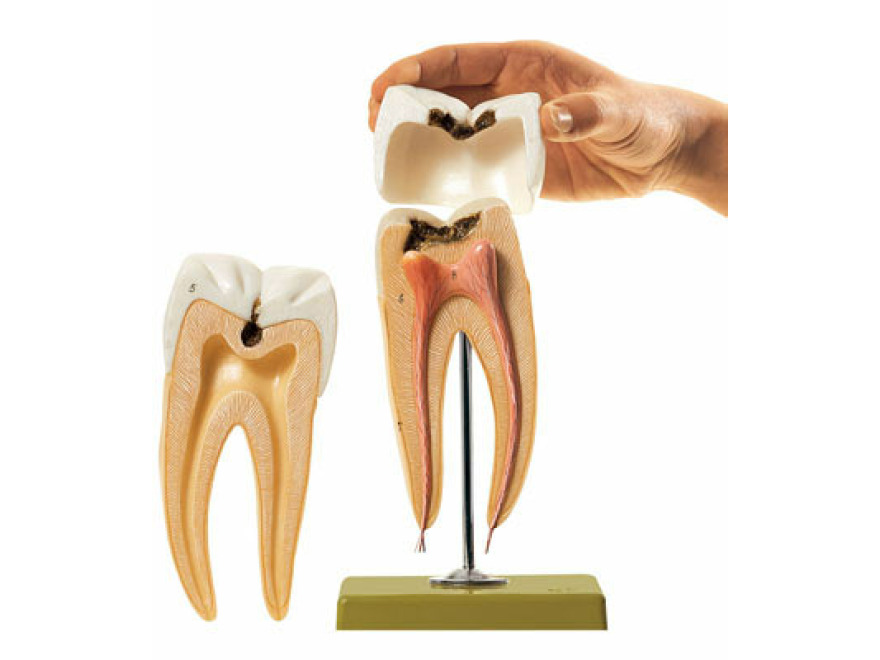 ES 8 - Stolička se zubním kazem