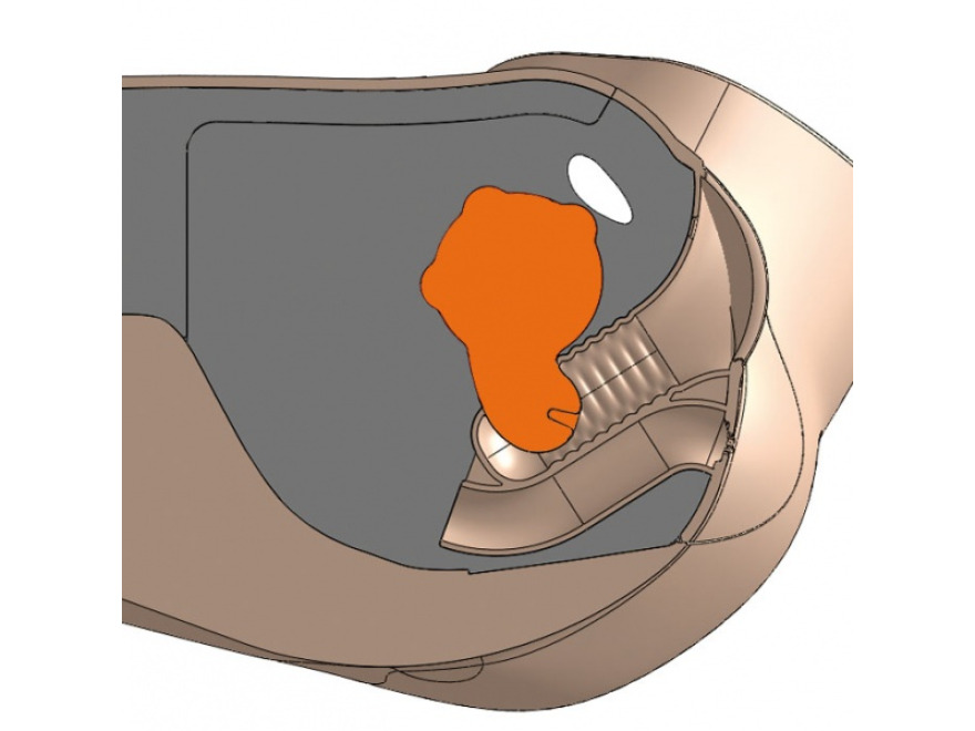 60921 - CFPT Modul 2: rozshl fibroid  vyheznut dlonho hrdla