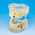 Transparentn model onemocnn zub (mln chrup)