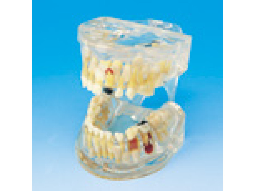 Transparentn model onemocnn zub (mln chrup)
