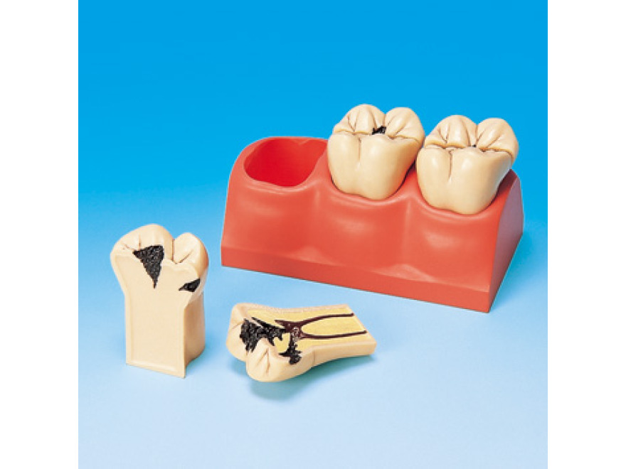 4× zvětšený model zubních kazů