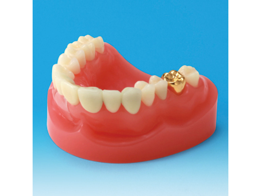 Model restaurace/náhrady zubu PE-PRO001