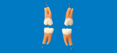 Model zubu s rozvětveným kořenem (zub č. 46)