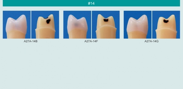 Model zubu se zubnm kazem (zub . 14)