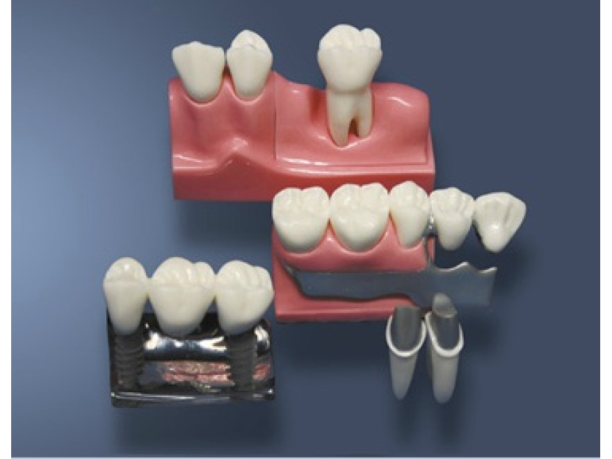 MDO-59 - Rekonstrukce odnmateln sten zubn protzy a implantt